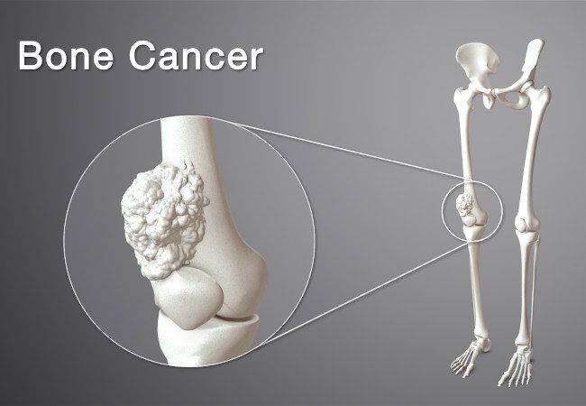 All About Bone Cancer: Risk Factors, Warning Signs, and Prevention  By Dr. Vishal Kulkarni