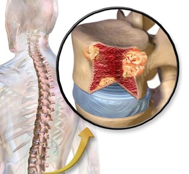 Kahler’s Disease (Multiple Myeloma): Understanding This Blood Cancer